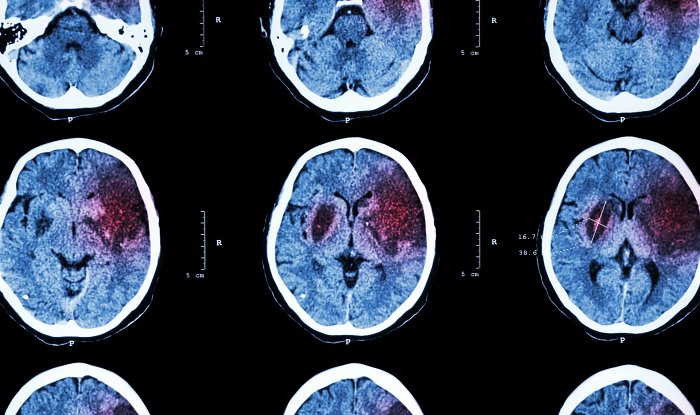 Модели машинного обучения научились быстро и точно диагностировать инсульт