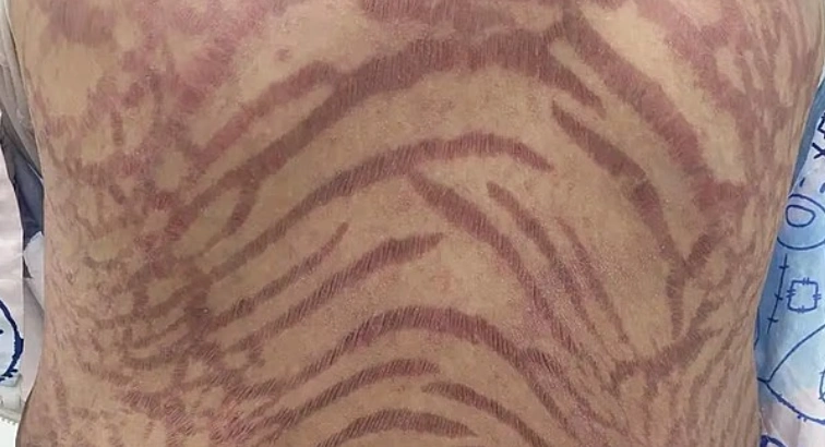 Крем из интернета превратил кожу женщины в «змеиный узор»