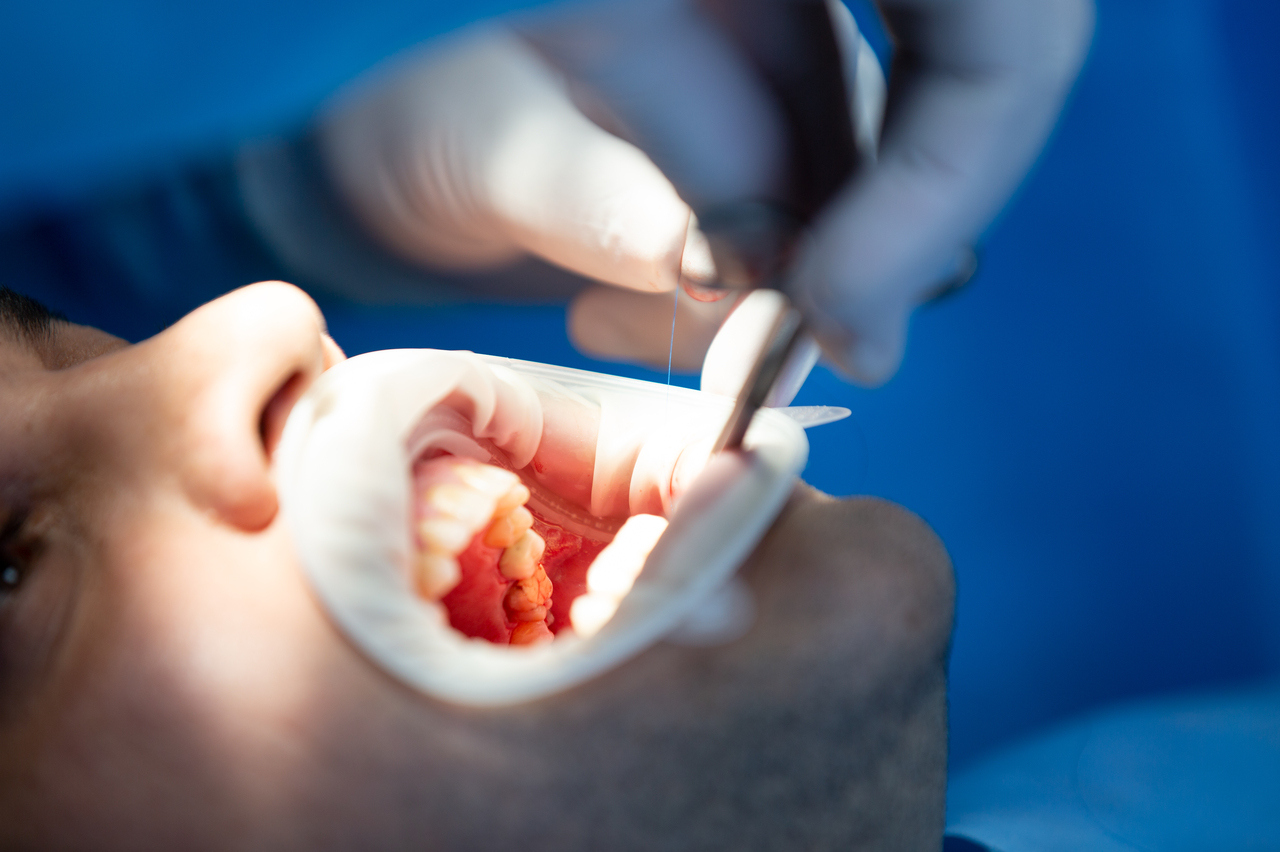Стоматолог перечислила продукты, убивающие зубы