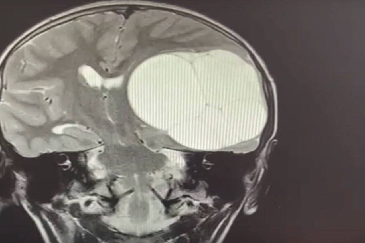 Челябинские врачи удалили из мозга ребенка кисту с личинками паразитов