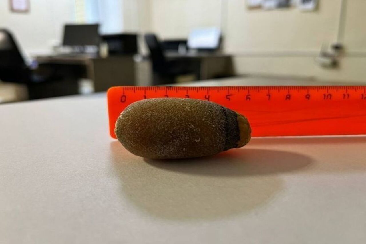 Башкирские врачи удалили пациентки желчный пузырь с камнем размером с куриное яйцо